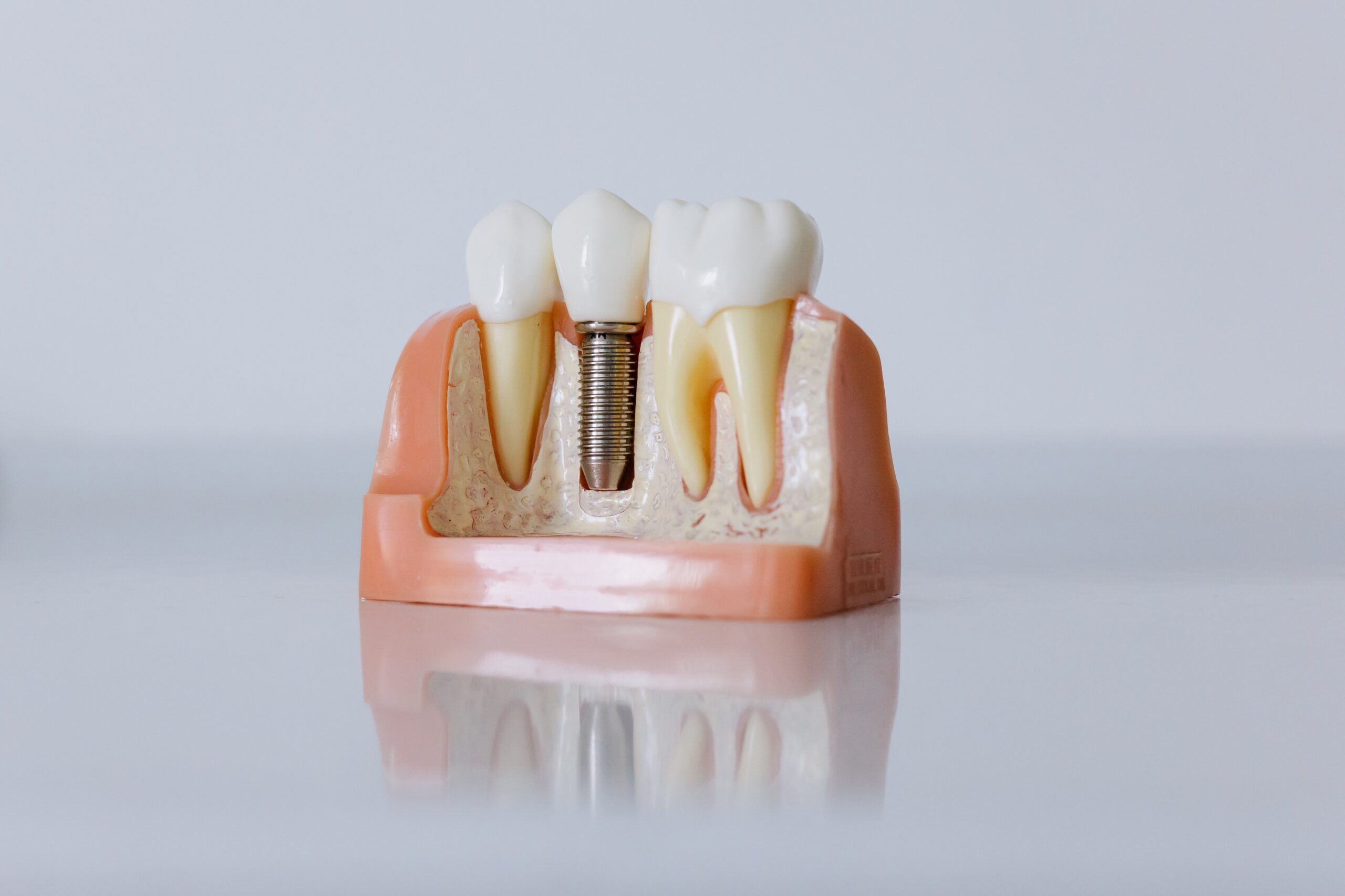 model implantu zęba